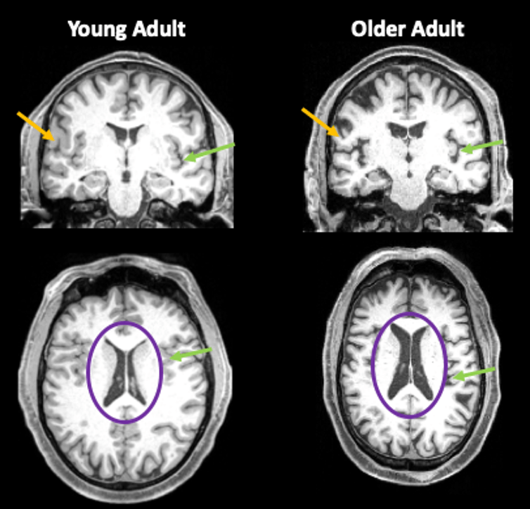 Black and white close up of brain scans from a 35-year-old and an 85-year-old comparing gray matter and cerebrospinal fluid levels